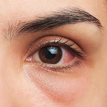 Eye Irritation Following Mold Testing in Naples, FL